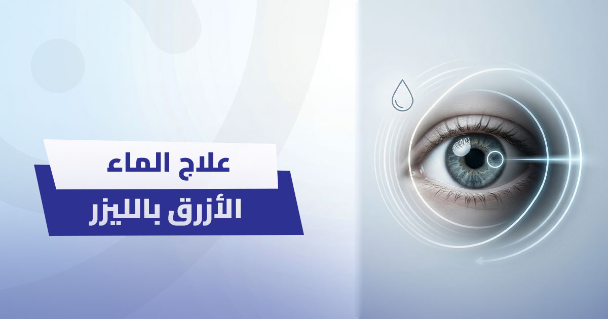 علاج الماء الأزرق بالليزر: متى يكون البديل الأفضل للقطرات؟