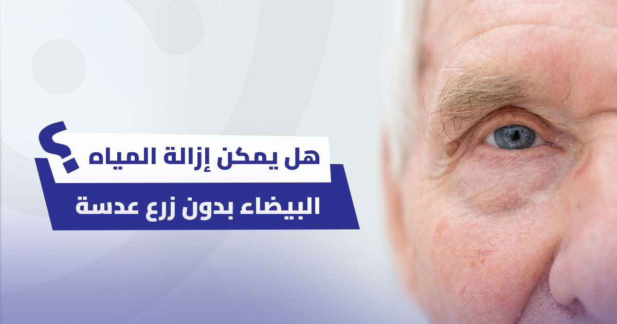 هل يمكن إزالة المياه البيضاء بدون زرع عدسة؟